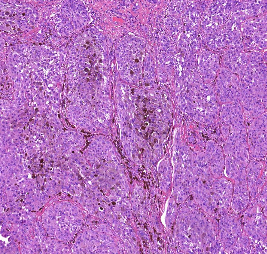 Melanoma malignum cutis1