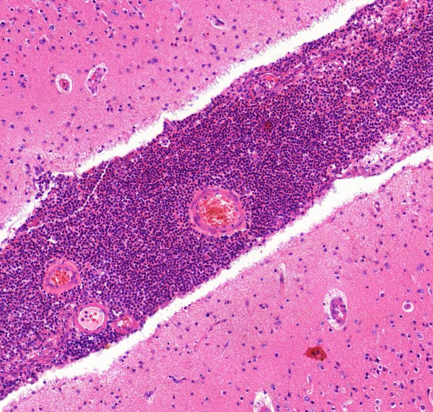 meningitis purulenta