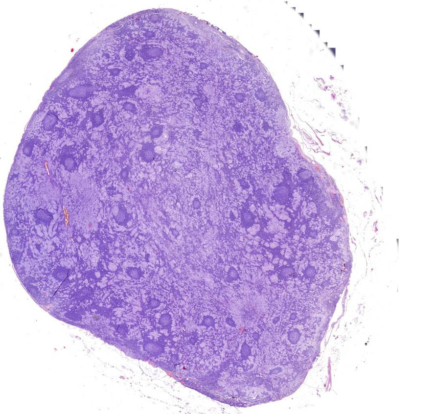 metastasis carcinomatosa lymphoglandularum