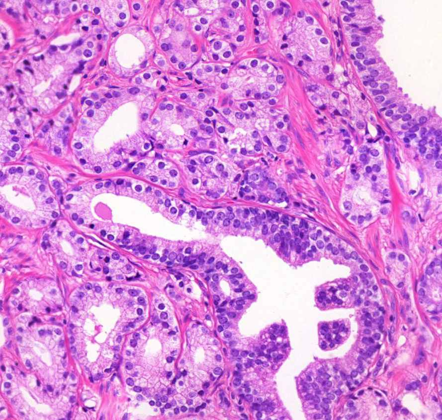 adenocarcinoma prostatae myoepithel