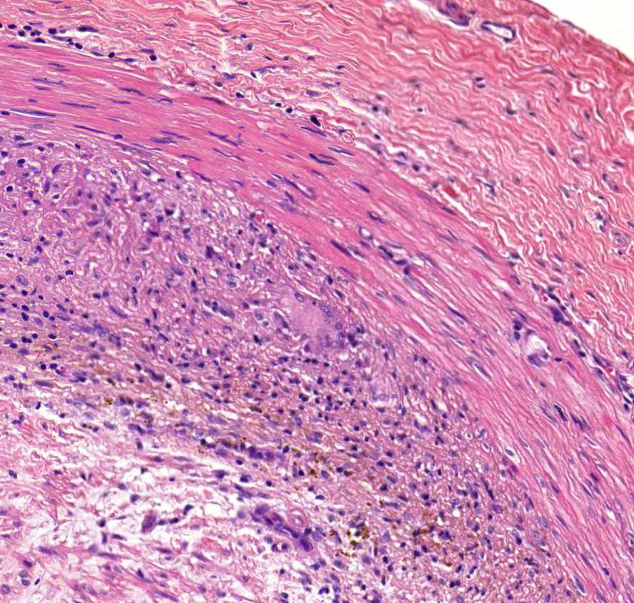 arteritis0