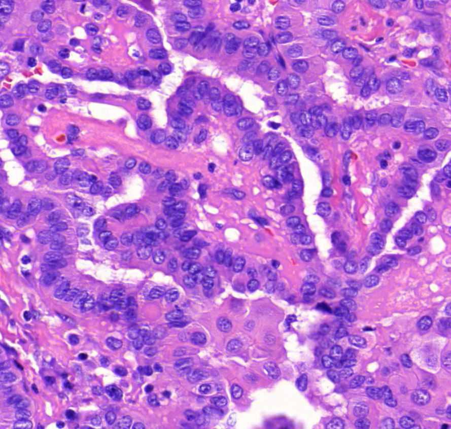 carcinoma papillare thyroideae magok