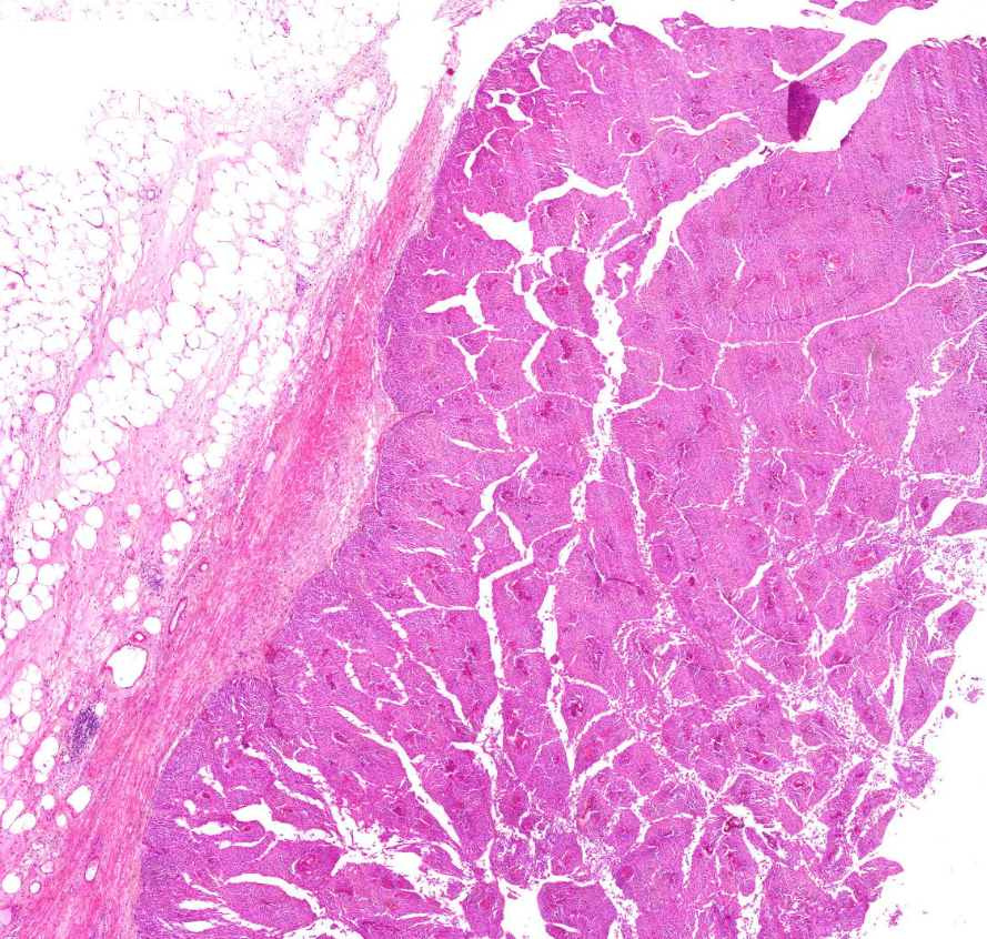 carcinoma transitiocellulare izomréteg