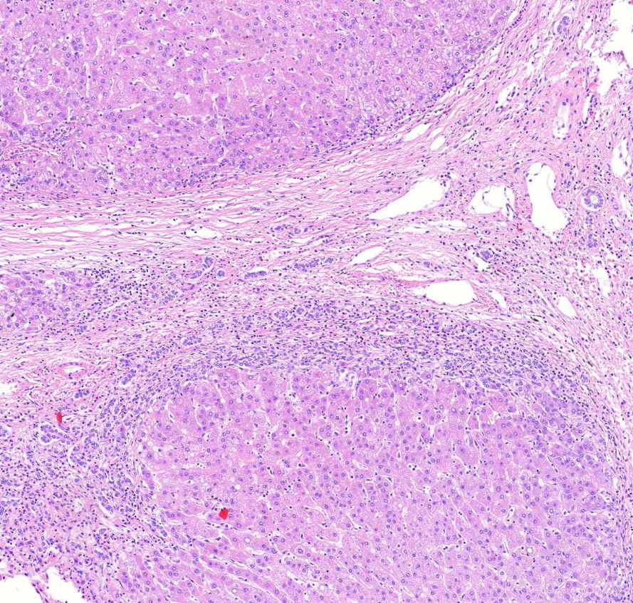 cirrhosis hepatis epeút-proloferáció