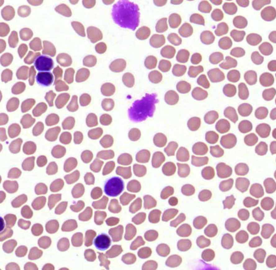 CLL - pv leszakadó fragmentumok - mutermék