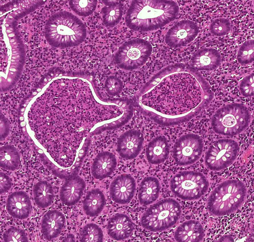 colitis ulcerosa 00