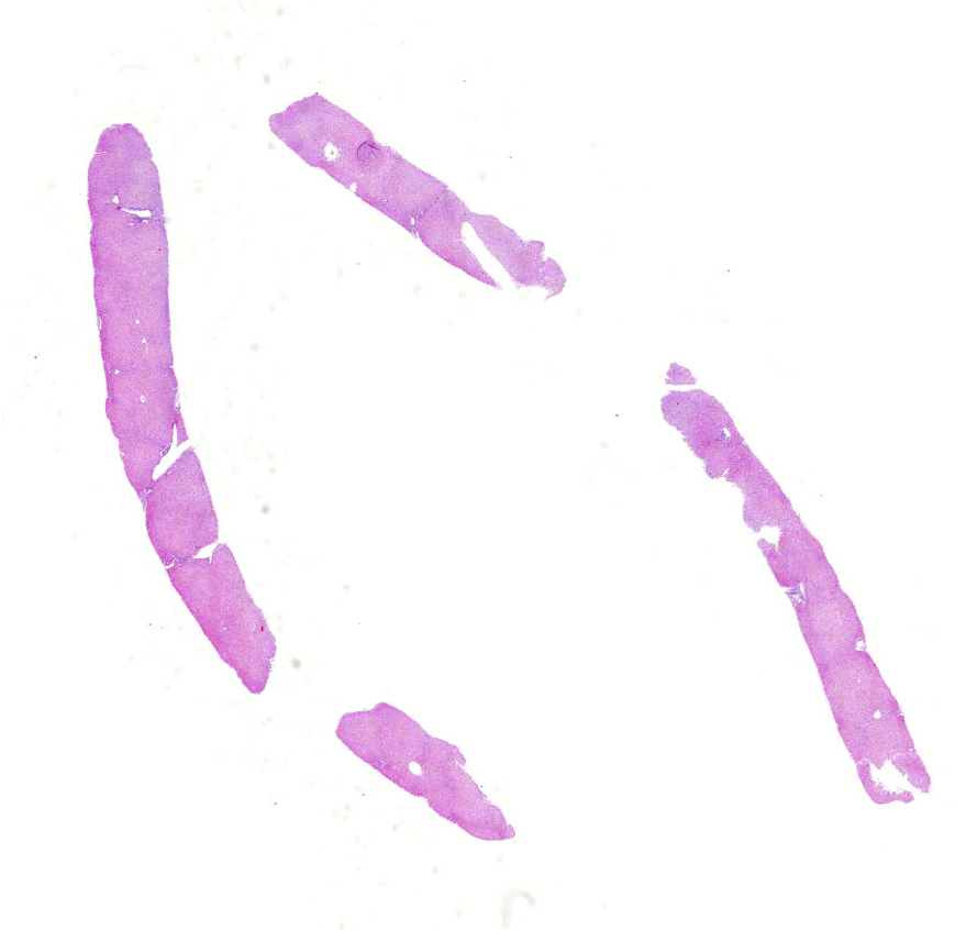 HBV-hepatitis