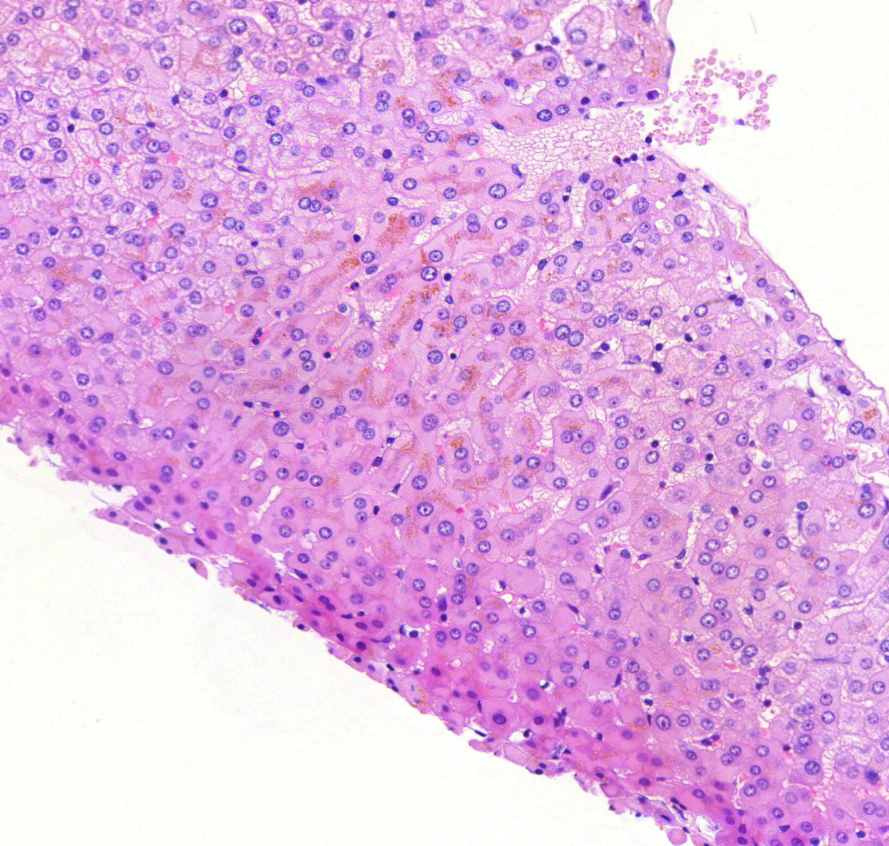 HBV-hepatitis0