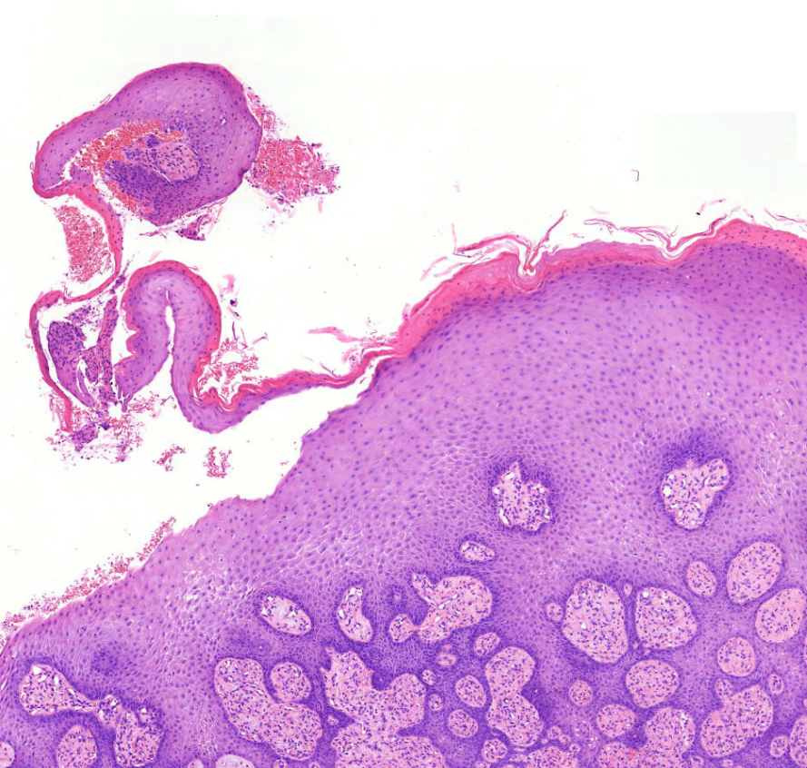 Kaposi sarcoma00