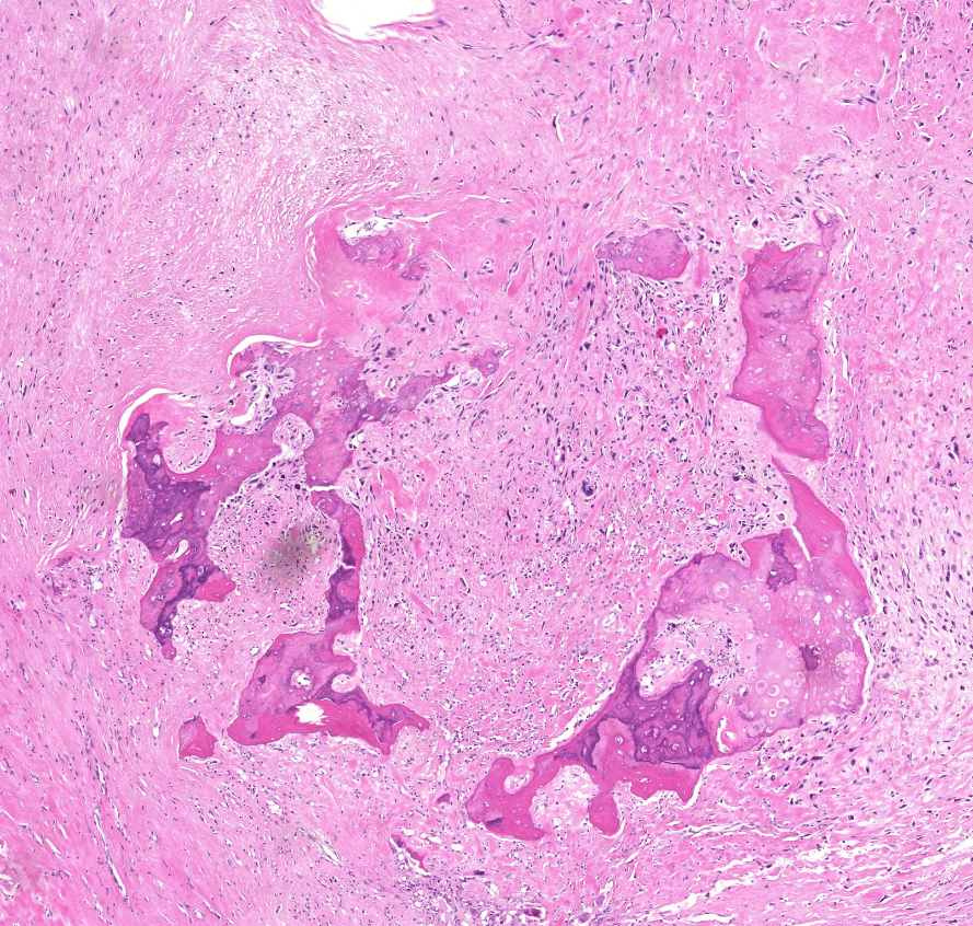 osteosarcoma osteoid