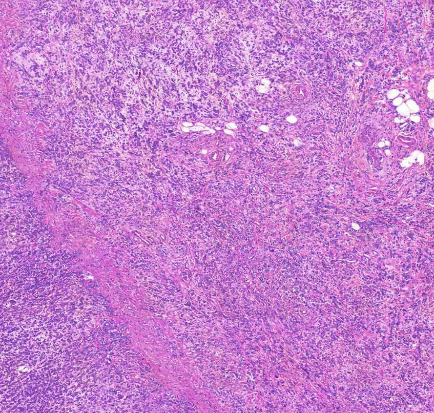 Adenocarcinoma ventriculi (diffuse type)0