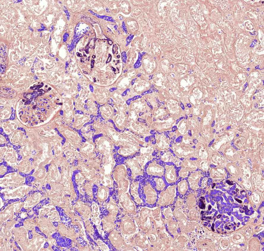 DIC (fibrin festes) 2