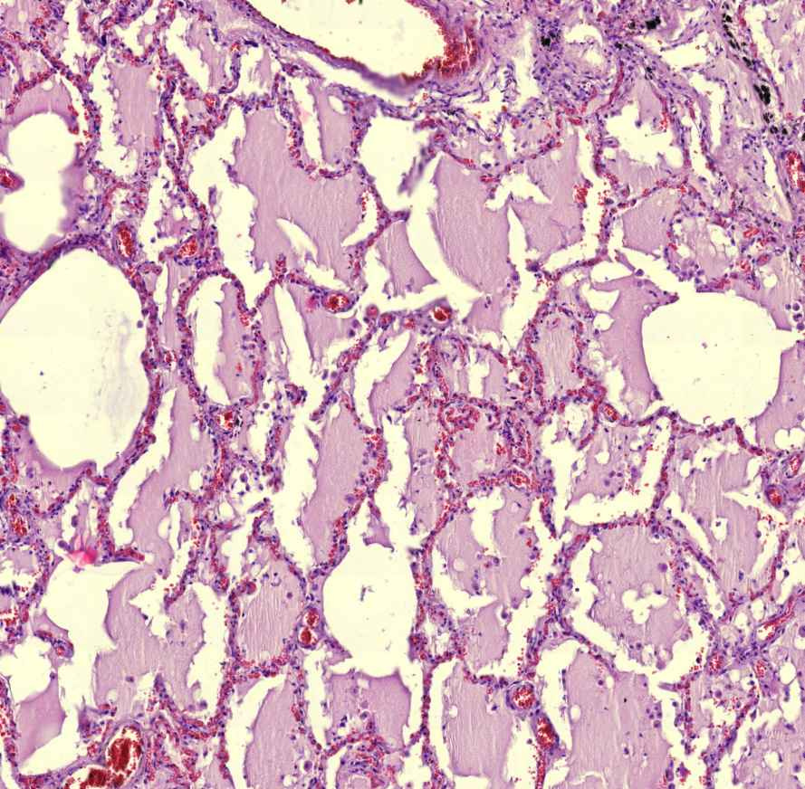 oedema pulmonis kapillárisok