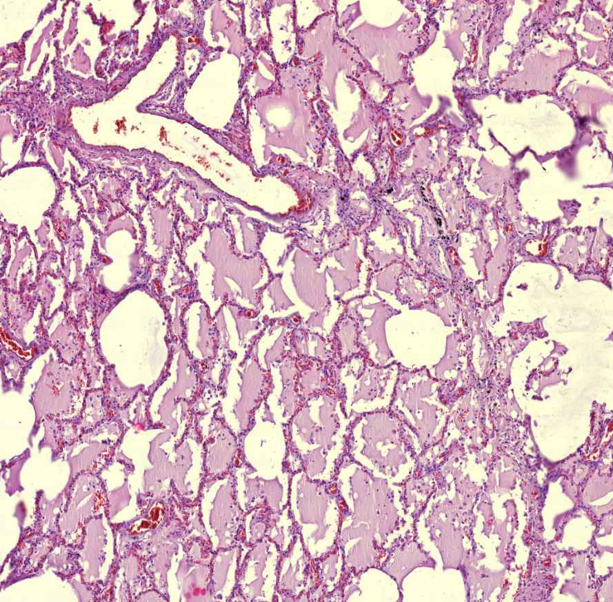 oedema pulmonis1