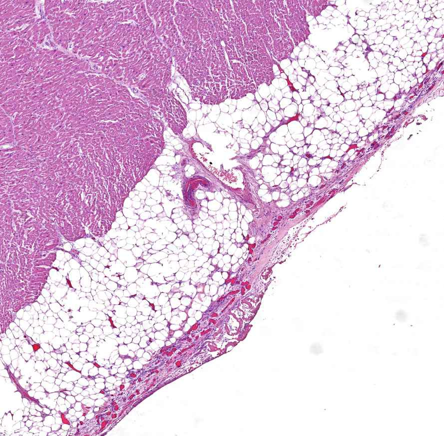 pericarditis fibrinosa