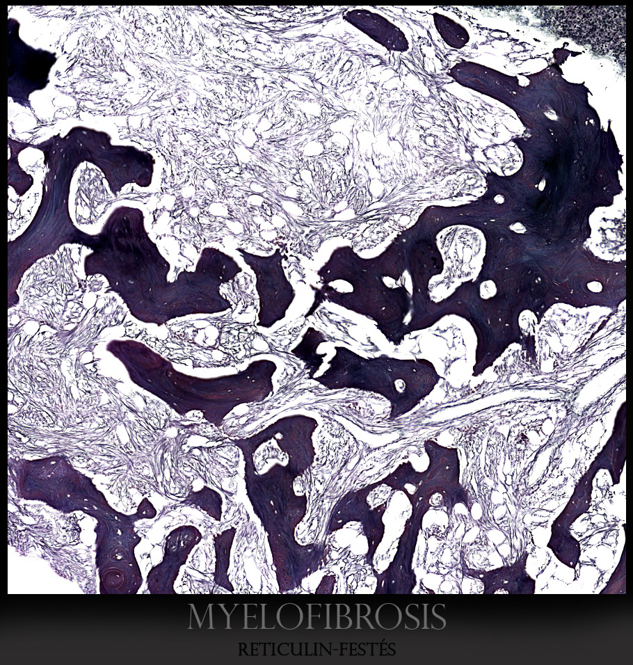 myelofibrosis